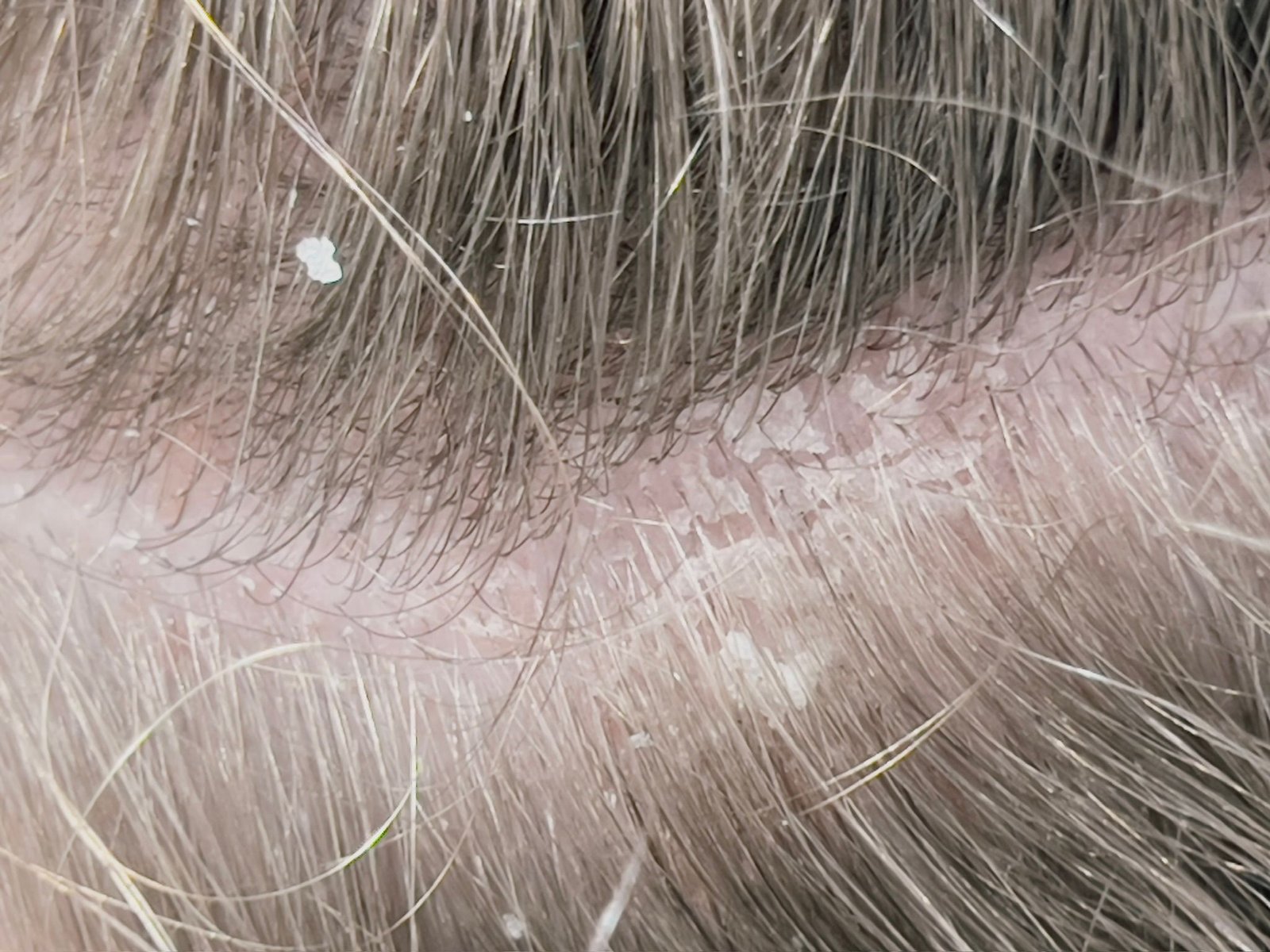 Trichology consultation and scalp analysis at About Hair Mackay, example 3