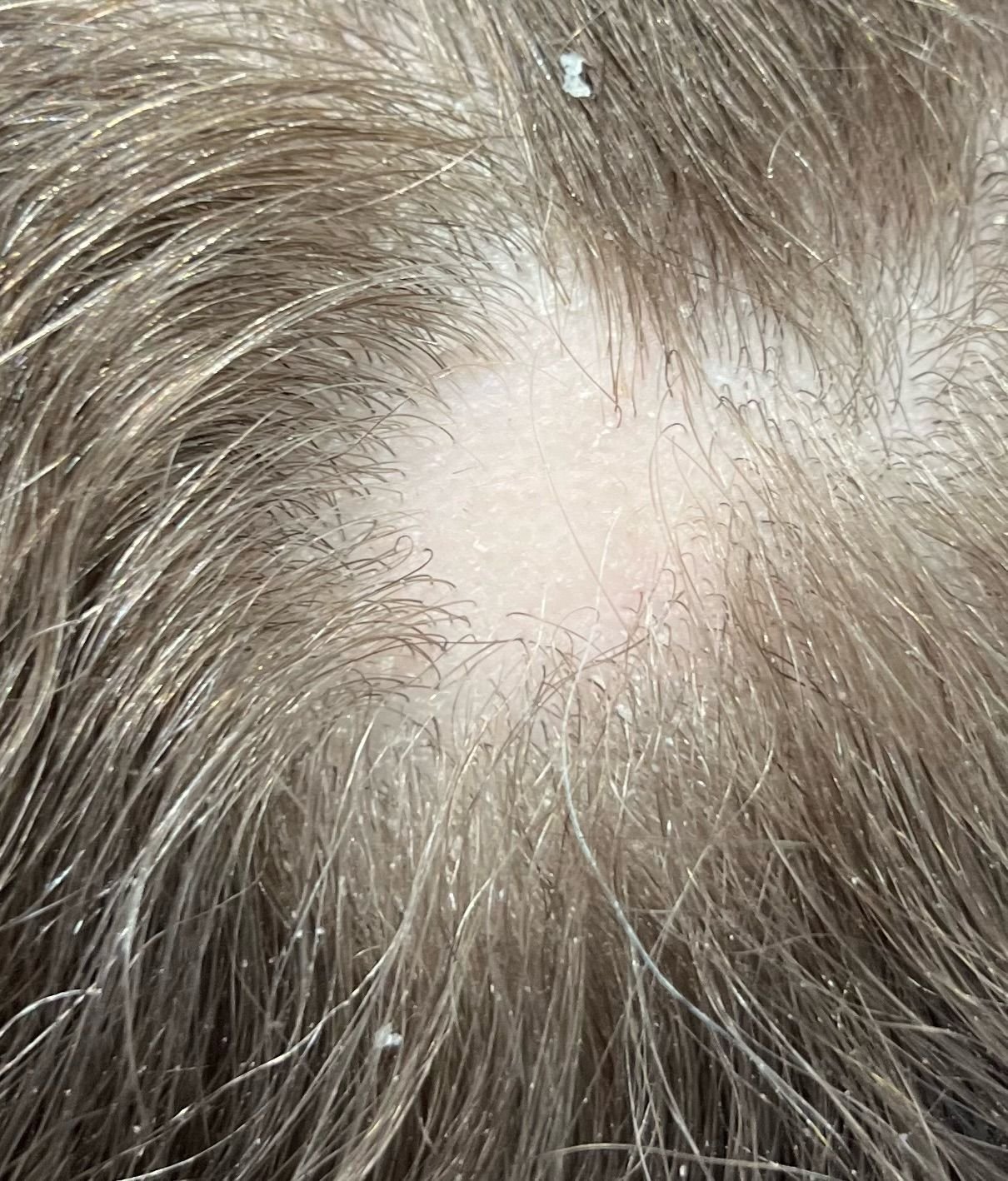 Trichology consultation and scalp analysis at About Hair Mackay, example 4