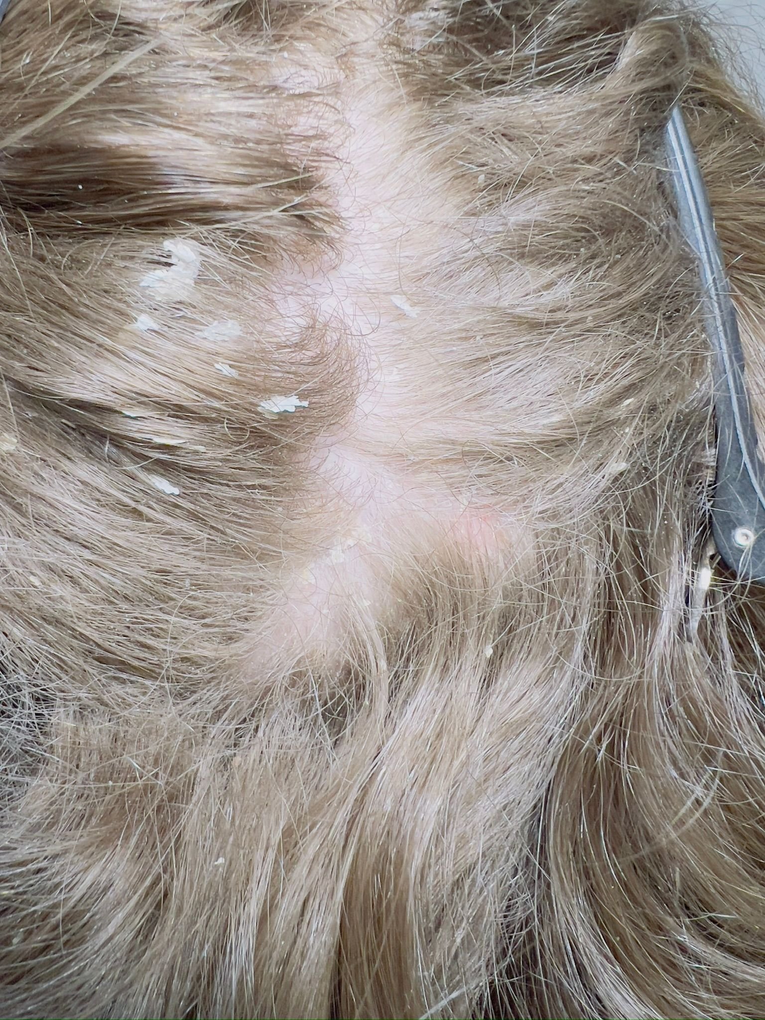 Trichology consultation and scalp analysis at About Hair Mackay, example 5