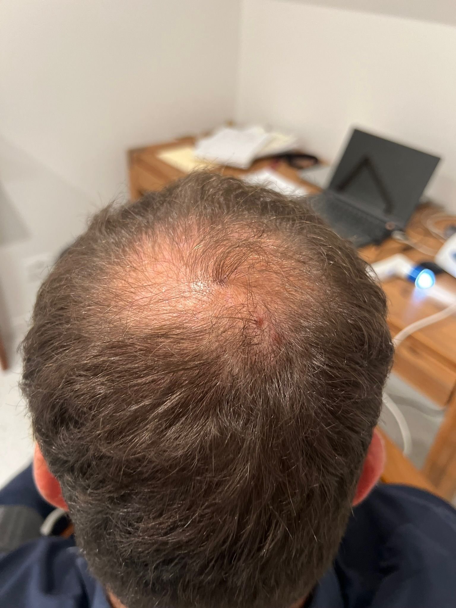 Trichology consultation and scalp analysis at About Hair Mackay, example 8